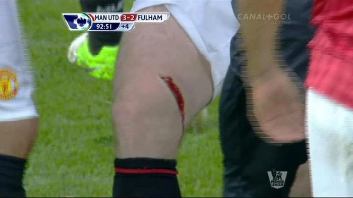 Trong một nỗ lực cản pha cú sút của Hugo Rodallega bên phía Fullham ở phút bù giờ thứ 3 của trận đấu, và Rooney đã bị đối thủ dẫm lên đùi...